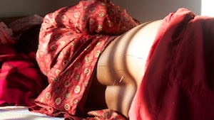 Lumbar Stenosis due to Osteoartritis