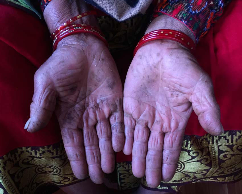 Acupuncture Relief Project  | Good Health Nepal | Beth Randles