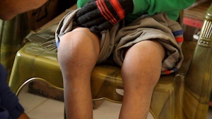 Acupuncture Case Study Acupuncture Case Study