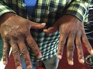 Acupuncture Case Study Acupuncture Case Study