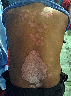 Acupuncture Case Study Acupuncture Case Study