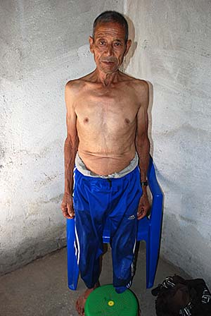 Acupuncture Case Study Acupuncture Case Study